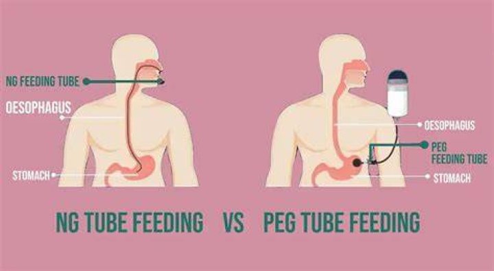 Are PEG tubes safe