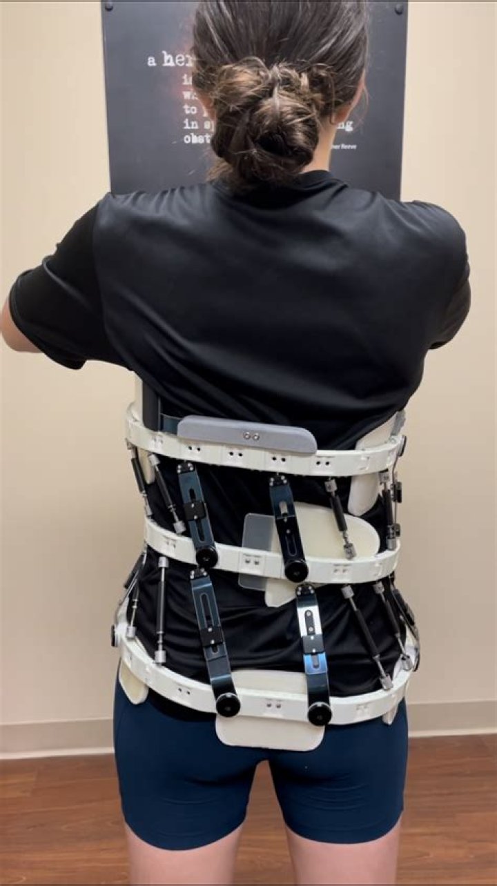 Can a back brace fix scoliosis