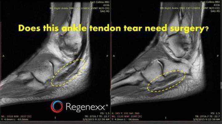 Can a peroneal tendon tear heal on its own