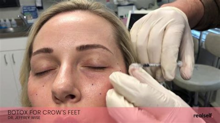 Can botox get rid of crows feet