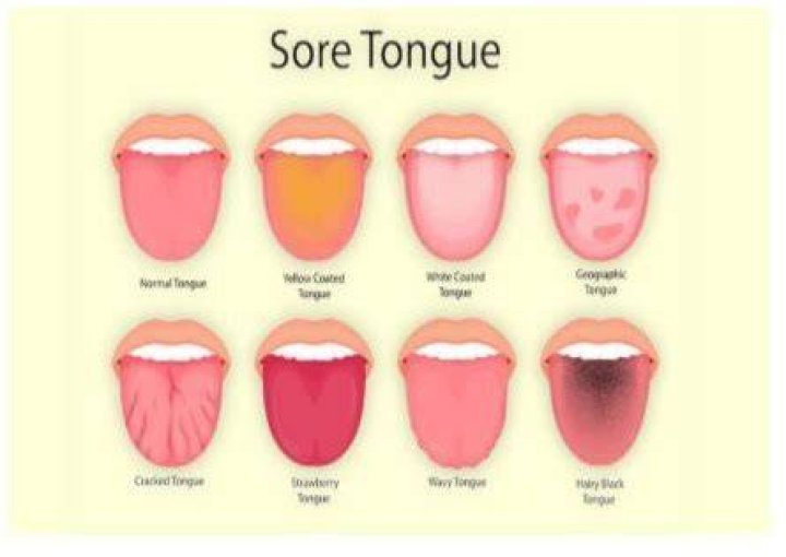Can cinnamon gum irritate tongue
