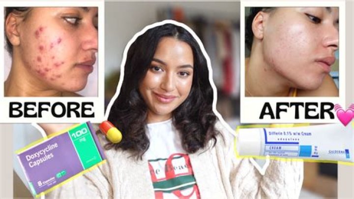 Can Tend Skin be used for acne