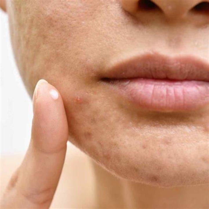 Can triamcinolone acetonide be used for acne