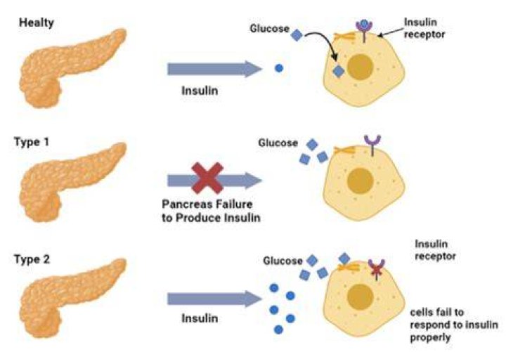 Can Type 2 diabetes be treated without insulin