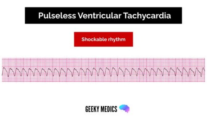 Can you shock Vtach
