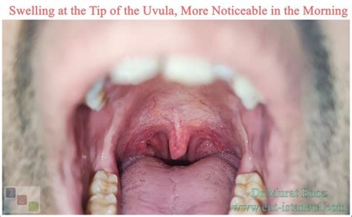 Can you talk without a uvula