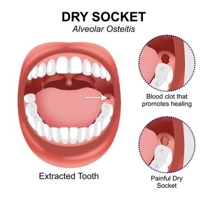 Can you use eugenol on dry socket