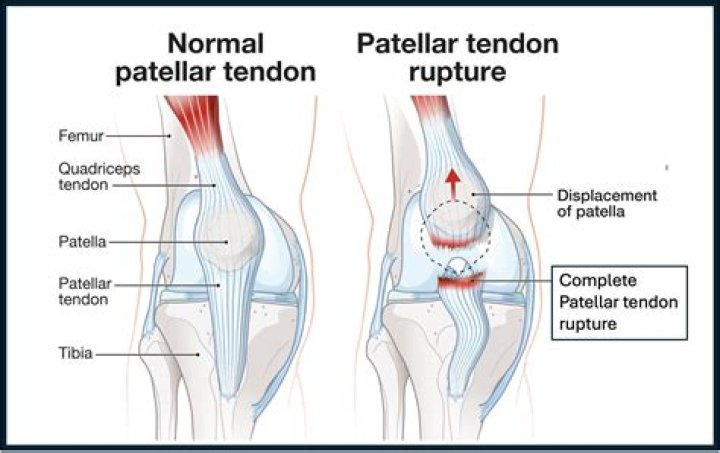 Does a torn peroneal tendon require surgery