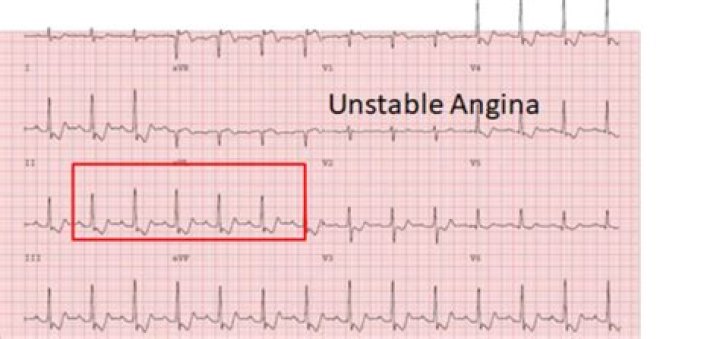 Does angina show on ECG