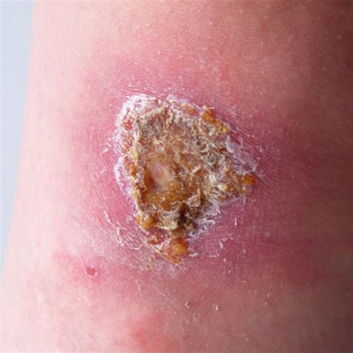 Does redness around wound mean infection