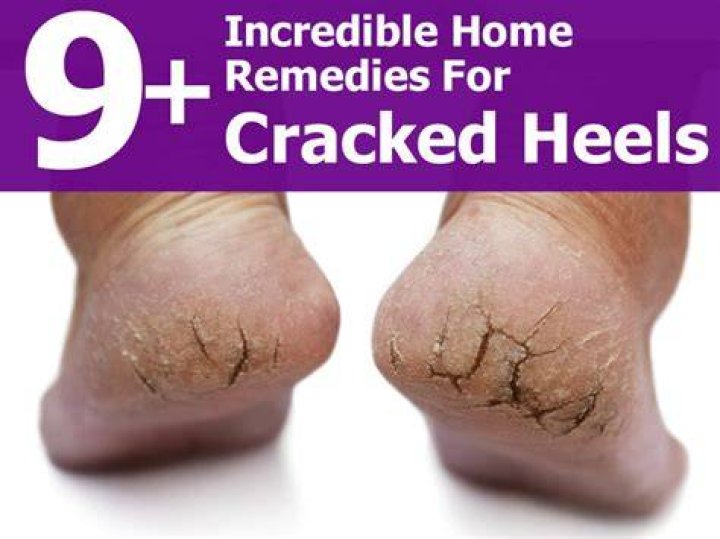 How can I heal my cracked heels at home