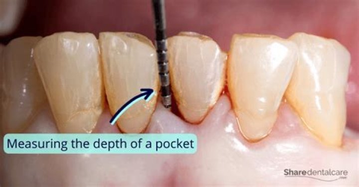 How do you calculate pocket depth
