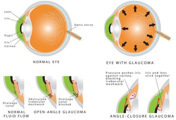 How is acute angle glaucoma diagnosed
