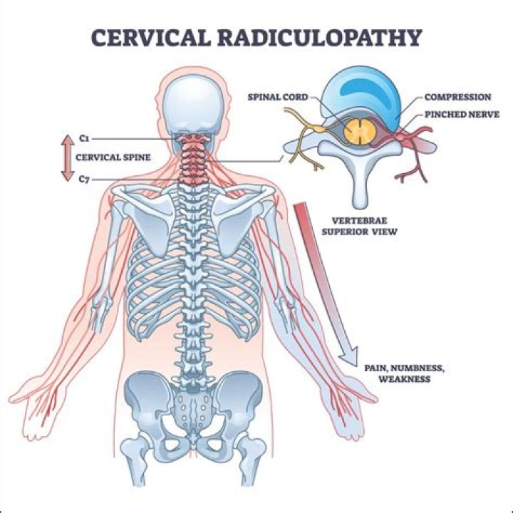 How is cervical radiculopathy tested