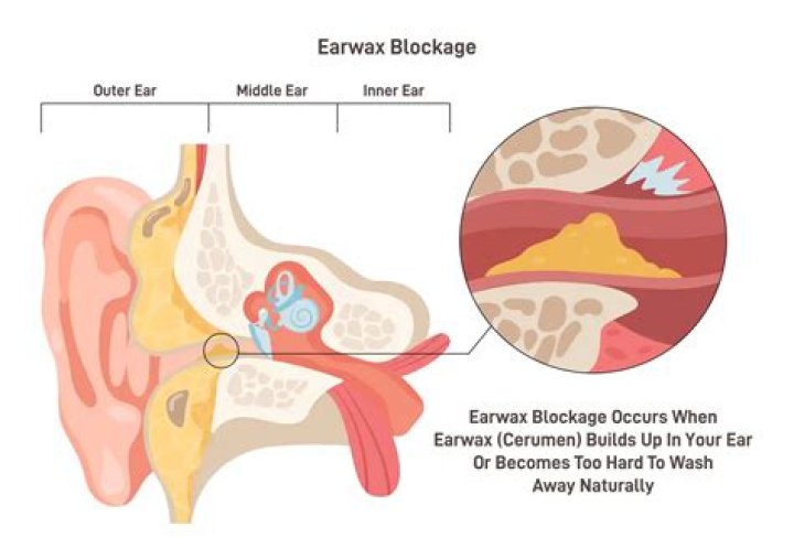 How is impacted cerumen treated