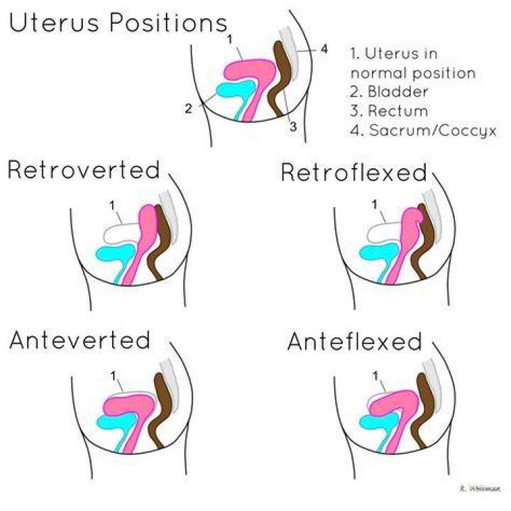 How is Retroverted uterus corrected