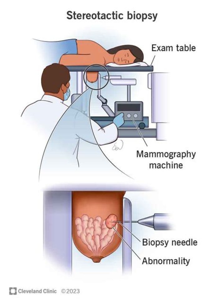 How painful is a stereotactic breast biopsy