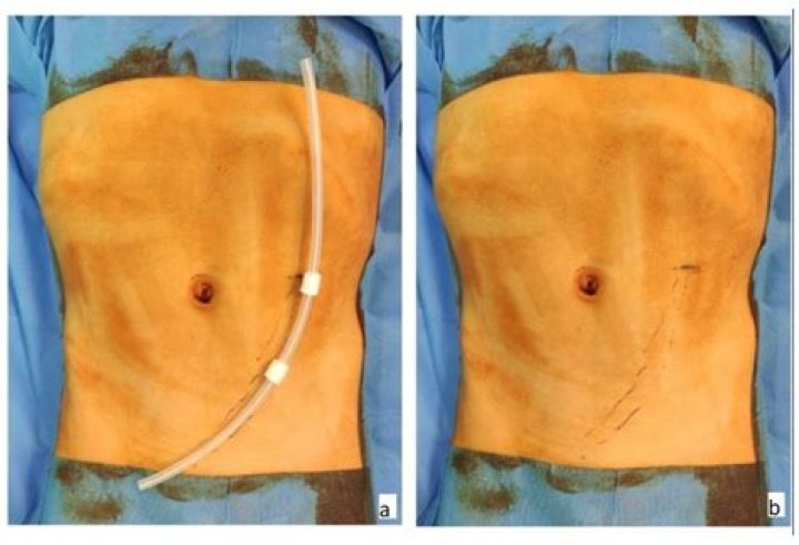Is a peritoneal dialysis catheter considered a surgical wound on Oasis