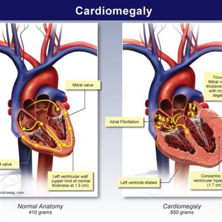 Is cardiomegaly serious