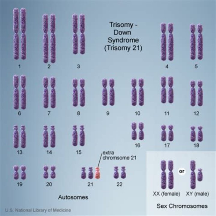 Is Down Syndrome genetically passed on