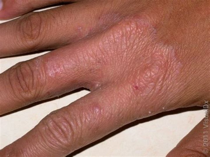 Is it eczema or fungal infection