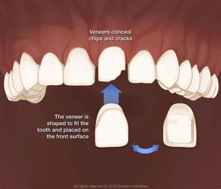 On which tooth surface is a veneer placed