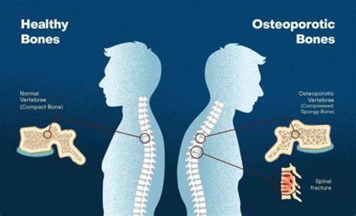 What are the symptoms of low bone density