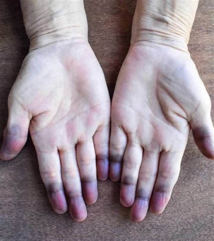 What bluish discoloration of the skin is associated with heart lung and circulatory diseases