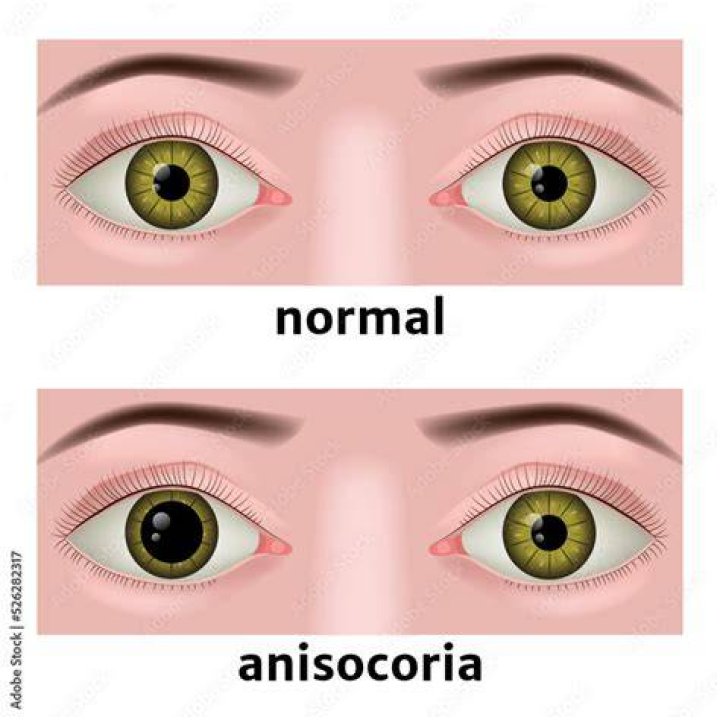 What causes Anisocoria