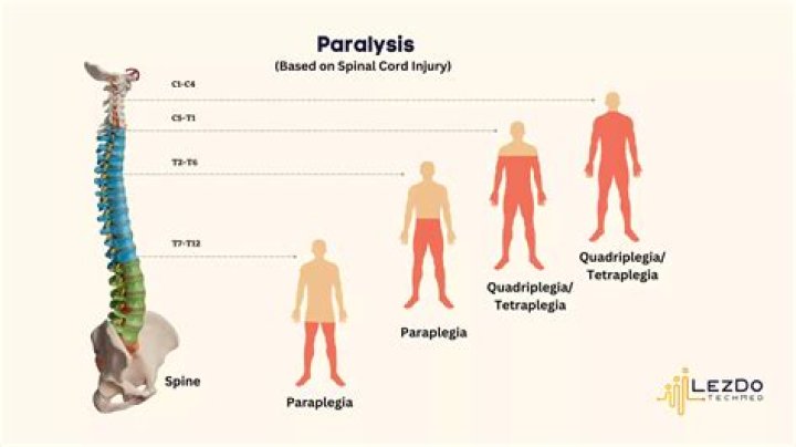 What causes descending paralysis