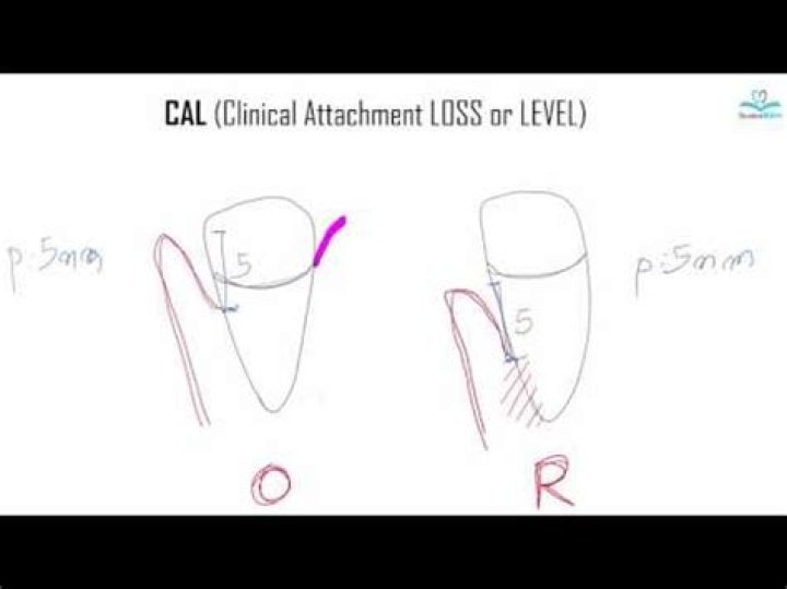 What does Cal mean in dentistry