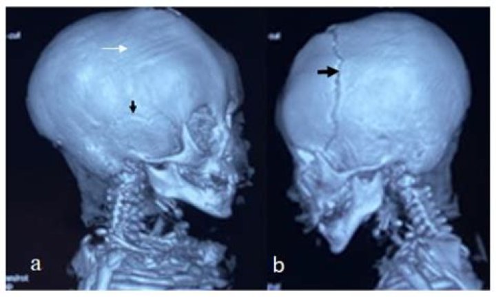 What does Craniomalacia mean