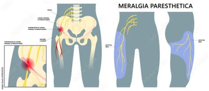 What does Meralgia mean