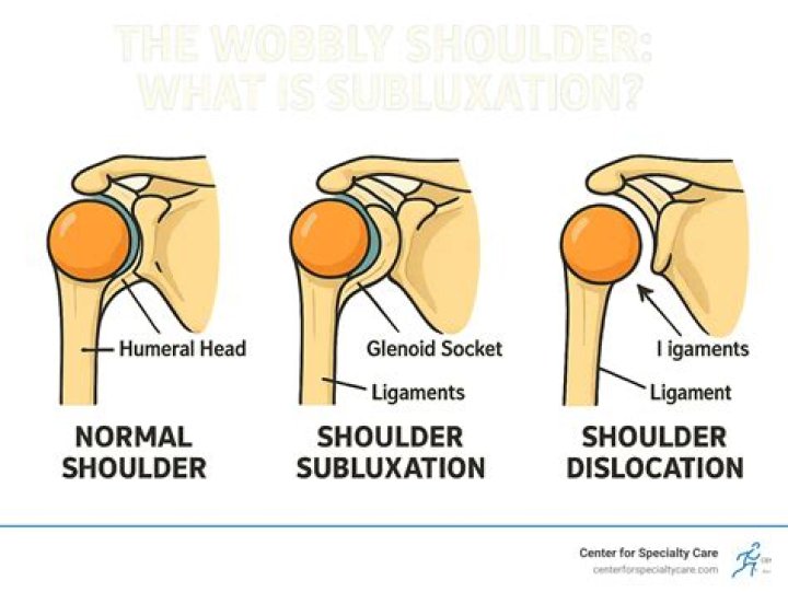 What does subluxation feel like