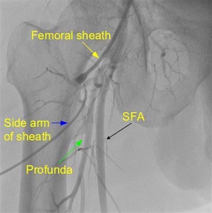 What is a femoral arterial sheath