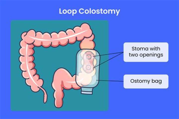 What is a ileostomy stoma