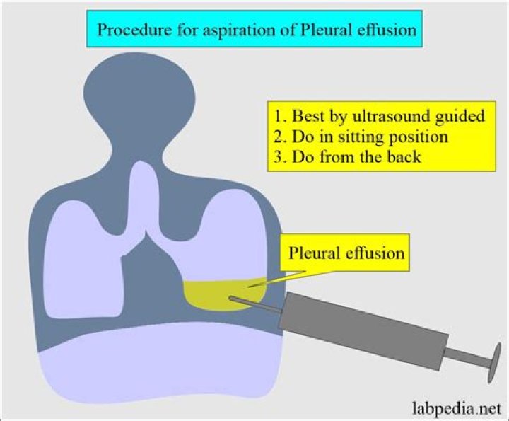 What is a puncture aspiration