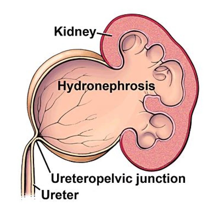 What is a UPJ obstruction