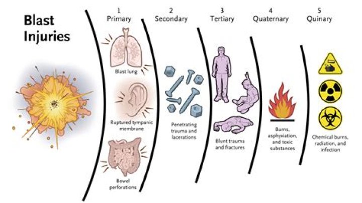 What is blast lung injury