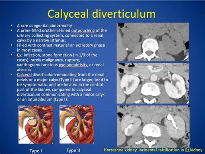 What is Calyceal