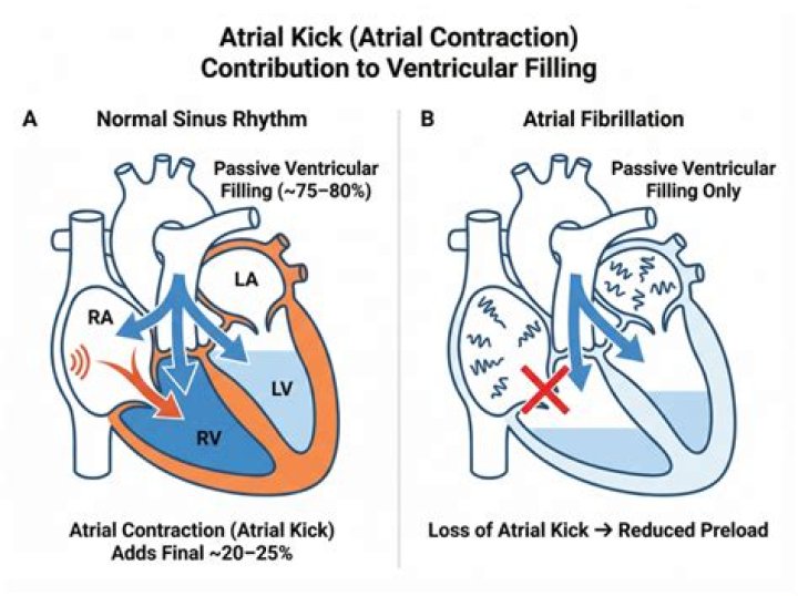 What is loss of atrial kick