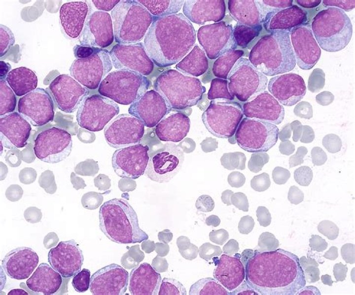 What is normal blast percentage in bone marrow
