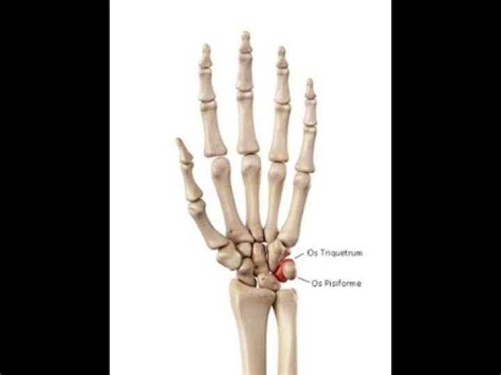 What is Pisiformectomy