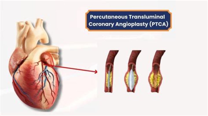 What is PTCA medical term