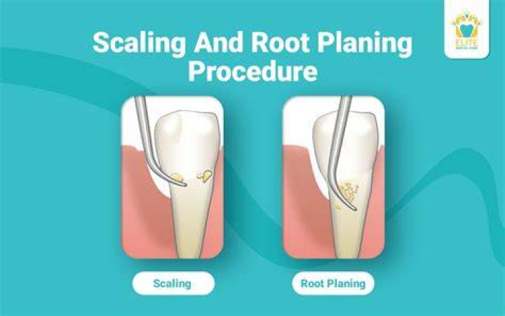 What is root planing and subgingival curettage