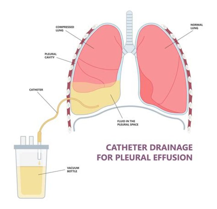 What is the difference between aspiration and drainage