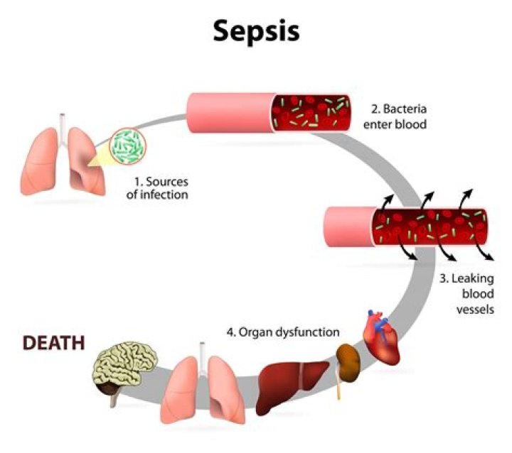 What is the difference between Urosepsis and sepsis