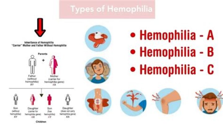 What is the difference of hemophilia A and B