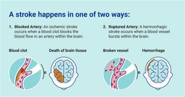 What is the most common cause of hemorrhagic stroke