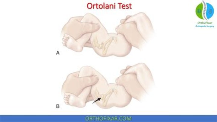 What is the Ortolani sign